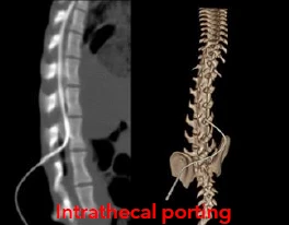 Intrathecal porting Intrathecal porting